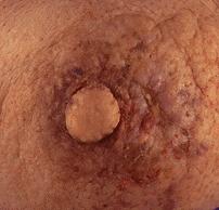 pagets-disease-of-breast